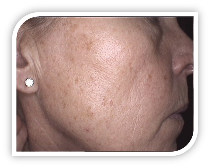 face wrinkles reduction skin rejuvenation